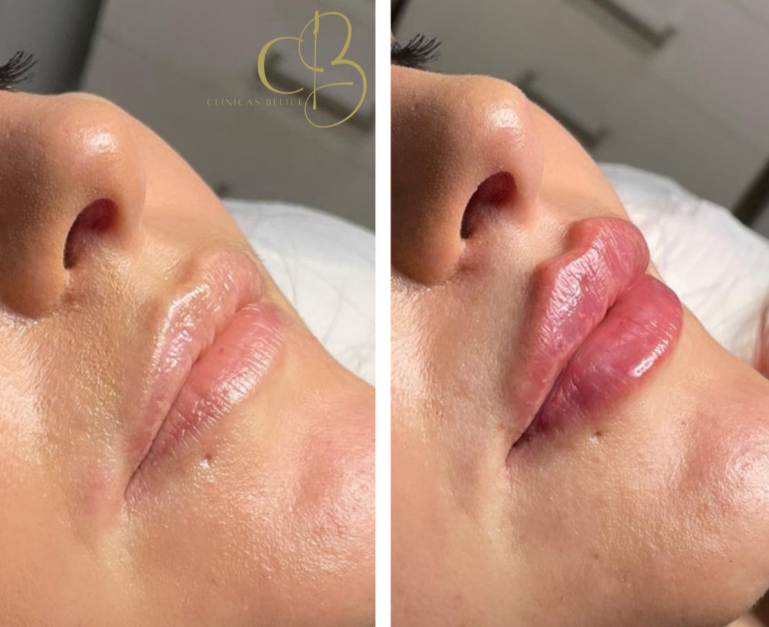 labios-rusos-clinicas-belice-1