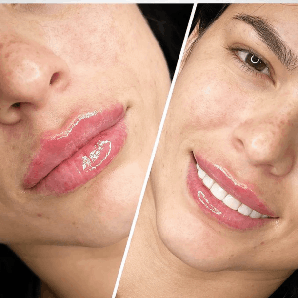 Antes y después de aumento de labios en Clínicas Belice en Valencia