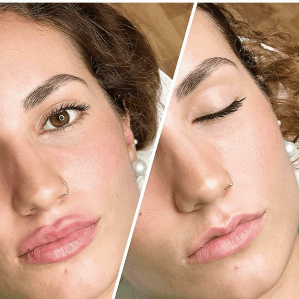 Antes y después de aumento de labios en Clínicas Belice en Valencia